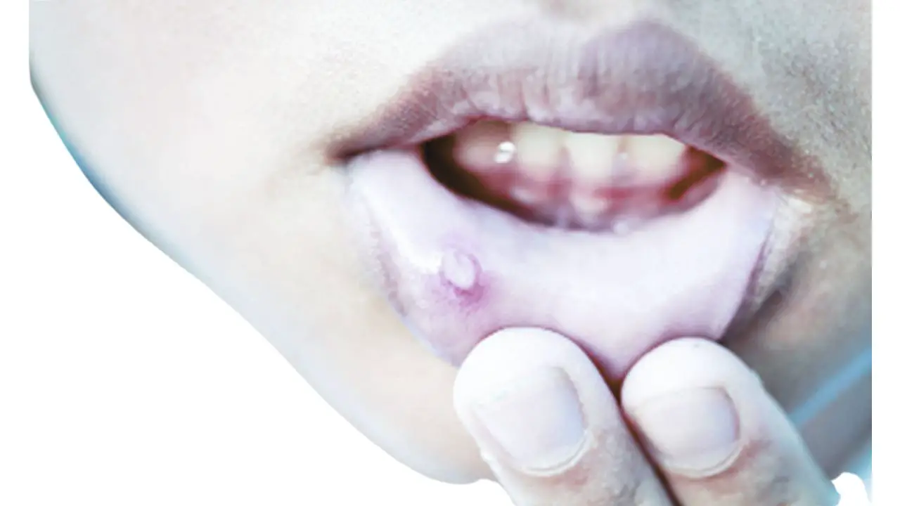 white sores in mouth