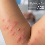 Tick Bite Nightmare What is Alpha-Gal Syndrome and How to Protect Yourself