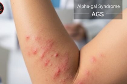 Tick Bite Nightmare What is Alpha-Gal Syndrome and How to Protect Yourself