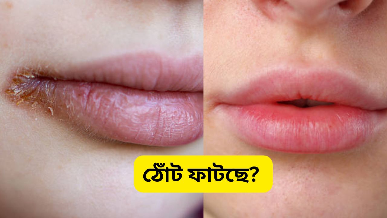 How to Cure Chapped Lips