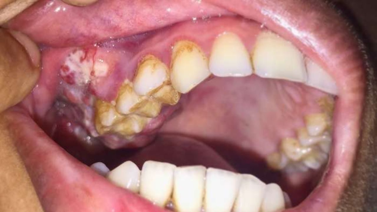 ভাঙা দাঁতের খোঁচা থেকে মুখের ক্যান্সার