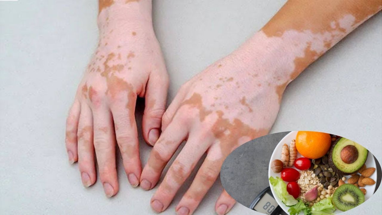 শ্বেতী রোগে কোন খাবার এড়িয়ে চলবেন