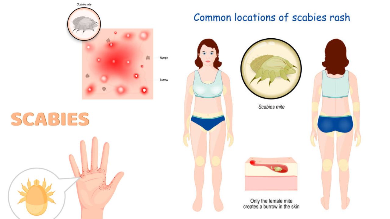 How to Remove Scabies Scars