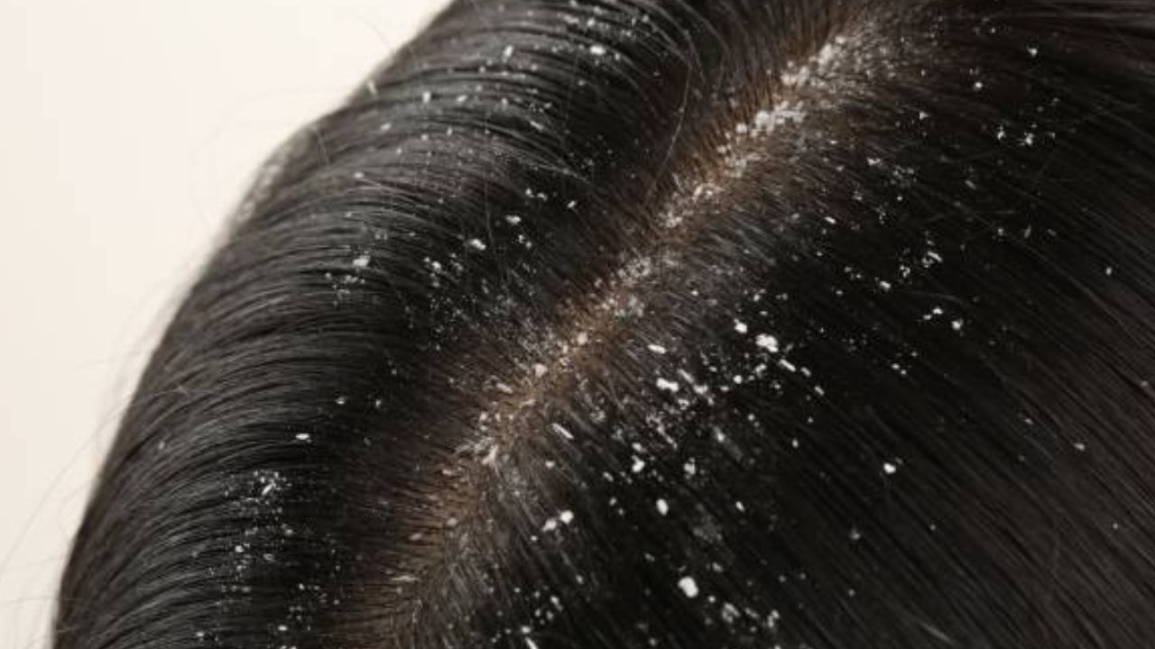 How to Deep Clean Your Scalp